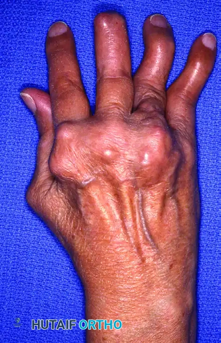Surgical Management of the Arthritic Hand: A Comprehensive Guide