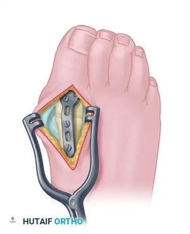 ARTHRODESIS OF THE FIRST METATARSOPHALANGEAL JOINT WITH RESECTION OF THE LESSER METATARSOPHALANGEAL JOINTS Surgical Diagram