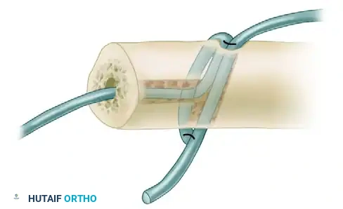 Arthrodesis of the Wrist: Surgical Techniques & Protocols