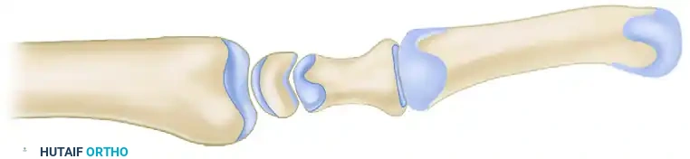 Total Wrist Arthrodesis & Scaphoid Subluxation Guide