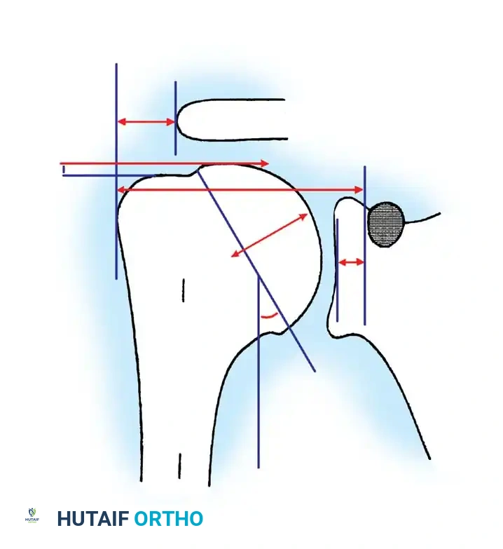 Arthroplasty of the Shoulder and Elbow Surgical Diagram