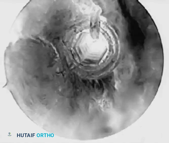 ARTHROSCOPIC BICEPS TENODESIS WITH A PERCUTANEOUS INTRAARTICULAR TENDON Surgical Diagram