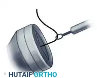 ARTHROSCOPIC BICEPS TENODESIS WITH A PERCUTANEOUS INTRAARTICULAR TENDON Surgical Diagram