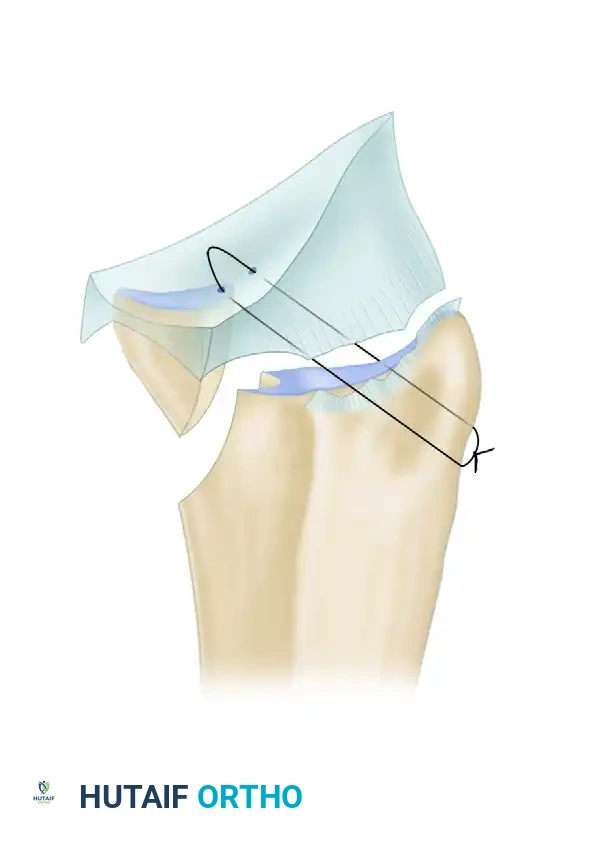 Arthroscopic Management of Triangular Fibrocartilage Complex Tears: Débridement and Foveal Repair
