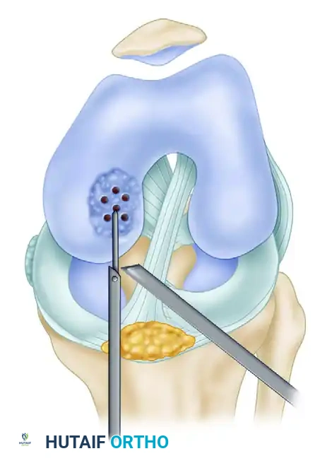 FIGURE 51-33 Technique for drilling intact lesion of osteo­ chondritis dissecans. Multiple perforations of lesion of medial femoral condyle are made using Kirschner wire through antero­ medial portal. SEE TECHNIQUE 51-13.