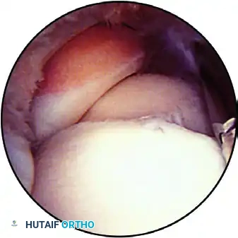 ARTHROSCOPIC ELBOW EXAMINATION Surgical Diagram