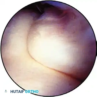 ARTHROSCOPIC ELBOW EXAMINATION Surgical Diagram