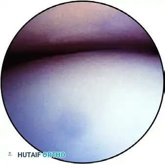 ARTHROSCOPIC ELBOW EXAMINATION Surgical Diagram