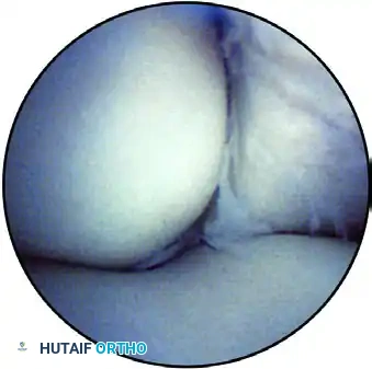 ARTHROSCOPIC ELBOW EXAMINATION Surgical Diagram