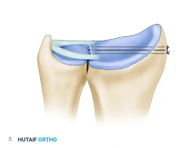 ARTHROSCOPIC REPAIR OF CLASS 1D INJURY Surgical Diagram