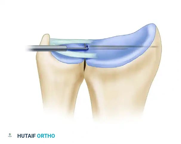 Arthroscopic Repair of Class 1D TFCC Injuries: A Master Surgical Guide