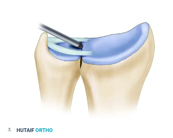 ARTHROSCOPIC REPAIR OF CLASS 1D INJURY Surgical Diagram