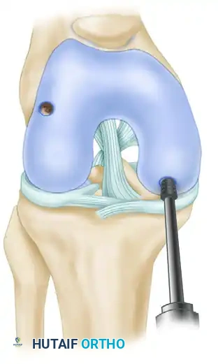 ARTHROSCOPIC SCREW FIXATION FOR OSTEOCHONDRITIS DISSECANS LESIONS IN THE MEDIAL FEMORAL CONDYLE Surgical Diagram