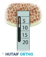 ARTHROSCOPIC SCREW FIXATION FOR OSTEOCHONDRITIS DISSECANS LESIONS IN THE MEDIAL FEMORAL CONDYLE Surgical Diagram