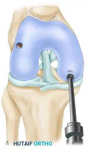ARTHROSCOPIC SCREW FIXATION FOR OSTEOCHONDRITIS DISSECANS LESIONS IN THE MEDIAL FEMORAL CONDYLE Surgical Diagram