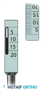 ARTHROSCOPIC SCREW FIXATION FOR OSTEOCHONDRITIS DISSECANS LESIONS IN THE MEDIAL FEMORAL CONDYLE Surgical Diagram