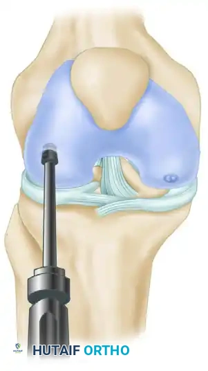 ARTHROSCOPIC SCREW FIXATION FOR OSTEOCHONDRITIS DISSECANS LESIONS IN THE MEDIAL FEMORAL CONDYLE Surgical Diagram
