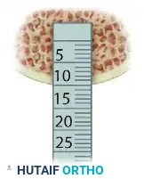ARTHROSCOPIC SCREW FIXATION FOR OSTEOCHONDRITIS DISSECANS LESIONS IN THE MEDIAL FEMORAL CONDYLE Surgical Diagram
