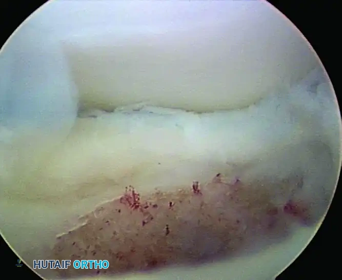ARTHROSCOPIC TREATMENT OF OSTEOCHONDRITIS DISSECANS Surgical Diagram