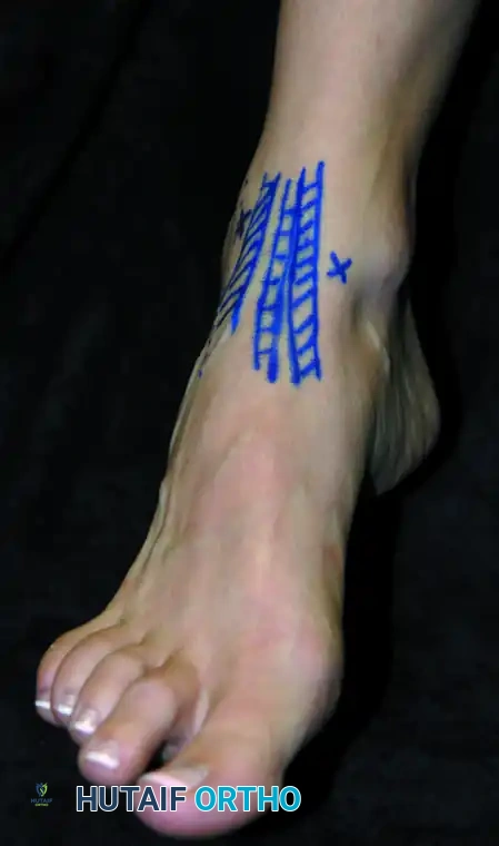 ARTHROSCOPY OF THE FOOT AND ANKLE Susan N. Ishikawa Surgical Diagram