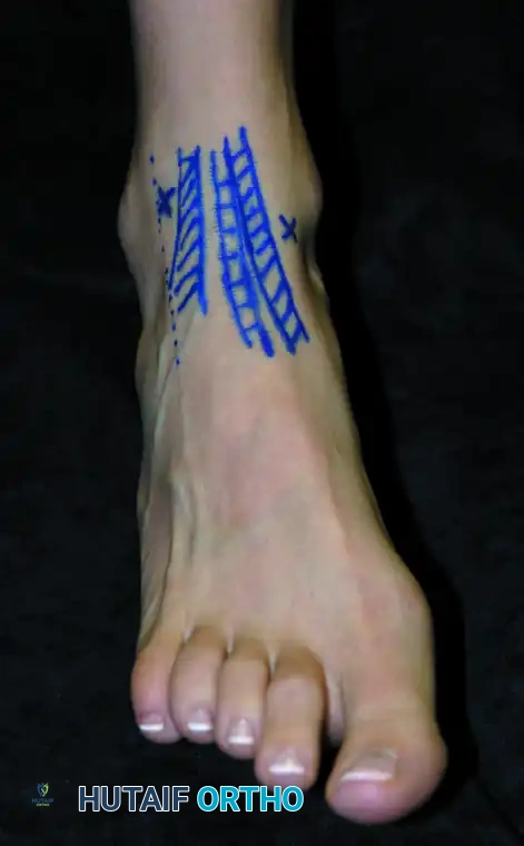 ARTHROSCOPY OF THE FOOT AND ANKLE Susan N. Ishikawa Surgical Diagram