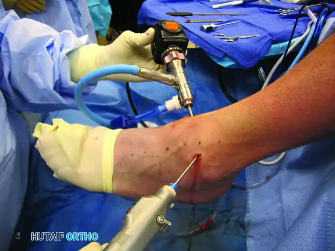 FIGURE 50-6 A, Synovitis in lateral ankle. B, After débridement. SEE TECHNIQUE 50-1.