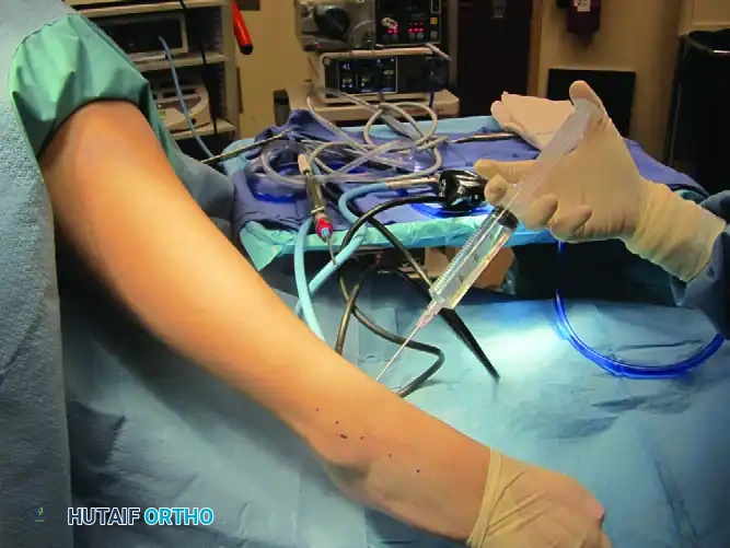 FIGURE 50-5 Anterolateral portal is made with blunt instru­ ment, followed by insertion of arthroscopic shaver. SEE TECH­ NIQUE 50-1.