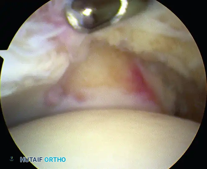 FIGURE 50-9 Forced plantar flexion test for diagnosis of pos­ terior ankle impingement.