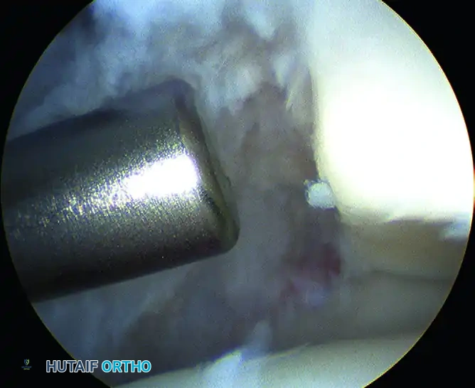 ARTHROSCOPY OF THE FOOT AND ANKLE Susan N. Ishikawa Surgical Diagram