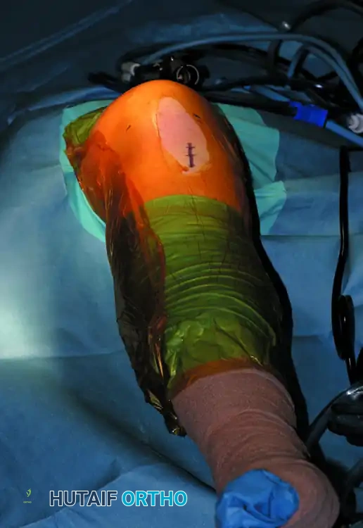 FIGURE 51-2 Technique of table-flat position. Surgeon and assistant stand at side of table.