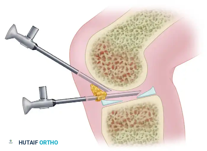 ARTHROSCOPY OF THE LOWER EXTREMITY Arthroscope Insertion and Triangulation
