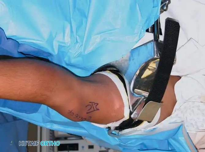 Fig. 48-1 Commercial leg holder that mounts to side rail of standard operating room table. With this particular commercial leg holder, pneumatic tourniquet is placed inside leg-holding device.