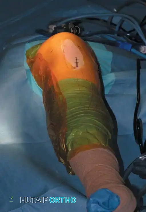 Fig. 48-2 Waterproof outer drape with central rubberized opening seals unsterile proximal thigh from operative ﬁ eld.