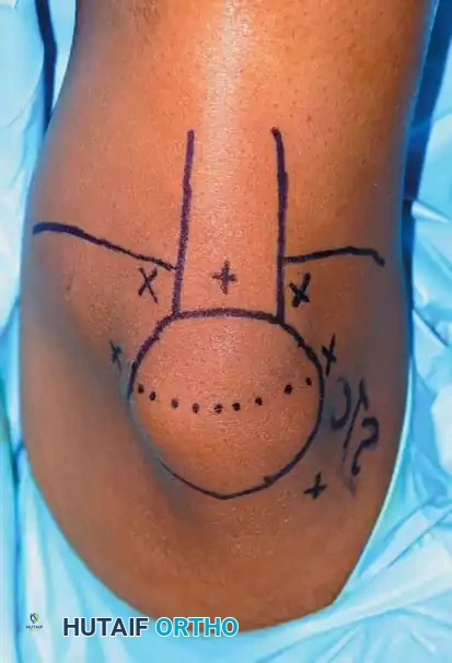 Fig. 48-4 Placement of lateral post and saline bag taped to table allow ease of leg positioning and full range of motion during ligament reconstruction.