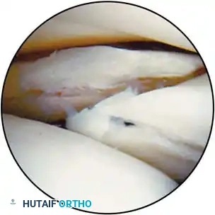 Torn lateral meniscus