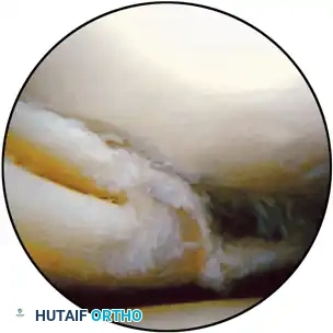 Torn lateral meniscus