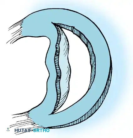 Fig. 48-11 Bucket-handle tear, displaced centrally. (Redrawn from Shahriaree H: O’Connor’s textbook of arthroscopic surgery, Philadelphia, 1984, Lippincott.)