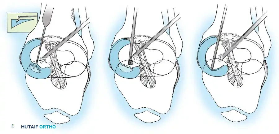 Arthroscopy of the Lower Extremity Surgical Diagram