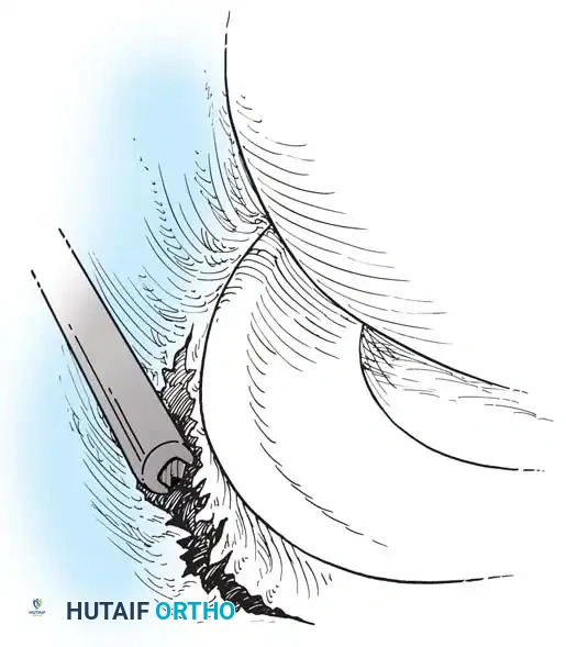 Fig. 48-23 Preparation of meniscocapsular tear of medial meniscus through accessory posteromedial portal. (Redrawn from Rosenberg TD, Scott SM, Coward DB, et al: Arthroscopic meniscal repair evaluated with repeat arthroscopy, Arthroscopy 2:14, 1986.)