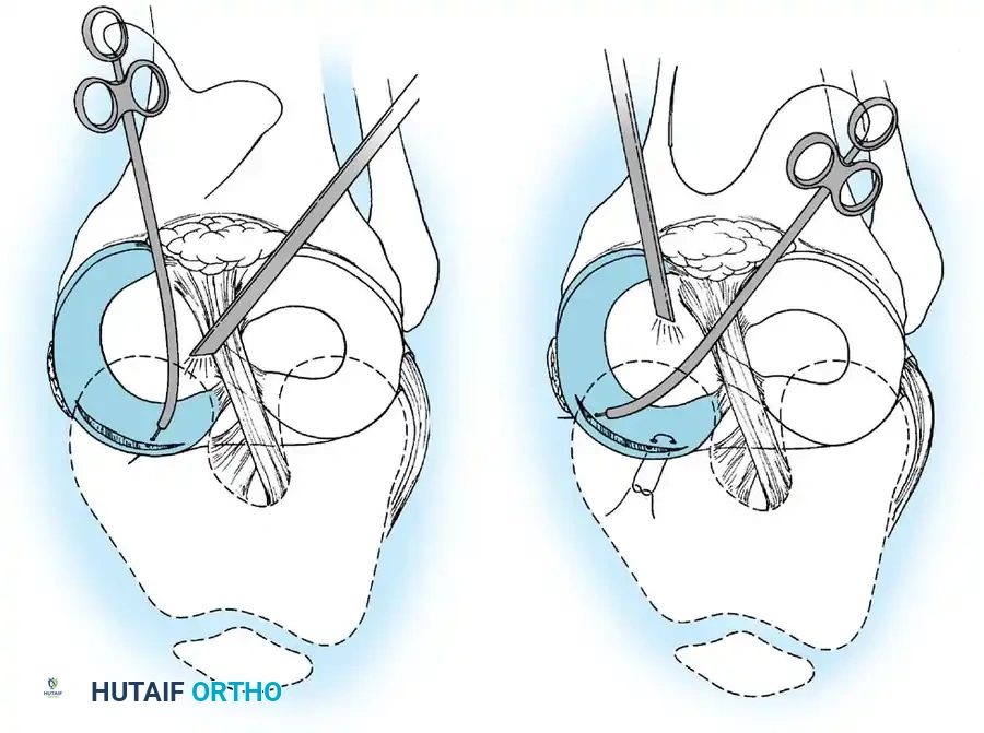 Arthroscopy of the Lower Extremity Surgical Diagram
