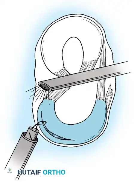 Fig. 48-33 All-inside technique. A, Proper posteromedial cannula placement begins outside and above medial hamstring tendons, above and behind posteromedial joint line, toward center of joint with knee ﬂ exed 90 degrees. B, Suture placement through posterior operative cannula with suture hook while viewing with 70-degree arthroscope through intercondylar notch. C, Knot tying is accomplished with arthroscopic knot pusher, which advances sequential throws through posterior cannula while viewing with 70-degree arthroscope through intercondylar notch. (Redrawn from Morgan CD: Technical note. The “all-inside” meniscus repair, Op Tech Sports Med 2:201, 1994.)