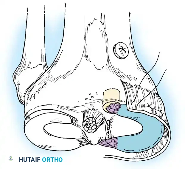 Arthroscopy of the Lower Extremity Surgical Diagram