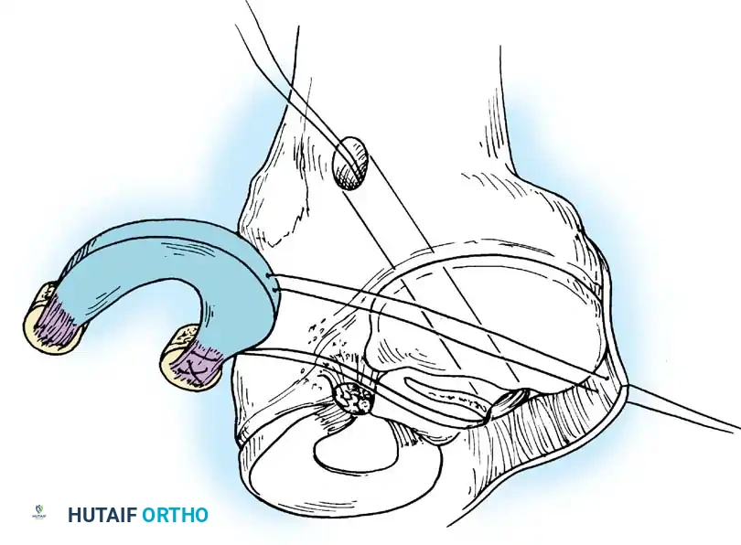 Arthroscopy of the Lower Extremity Surgical Diagram