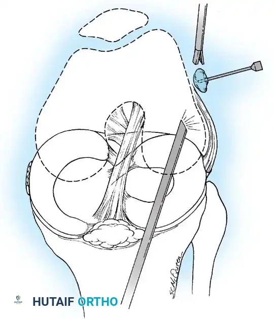 Fig. 48-35 Removal of loose body. Loose body is impaled with needle, and grasper is inserted through superolateral portal.