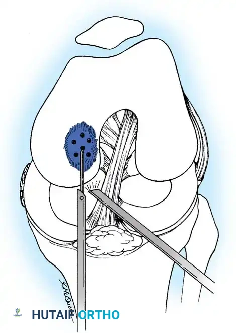 Fig. 48-38 Technique for drilling intact lesion of osteochondritis dissecans. Multiple perforations of lesion of medial femoral condyle are made using Kirschner wire through anteromedial portal.
