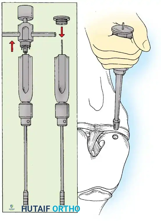 Fig. 48-40, cont’d G, Donor harvester, collared pin, and autograft core reinserted into driver. H, Donor tube harvester inserted into recipient socket. I, Sizer tamp, measuring 1  mm in diameter larger than bone core, positioned over bone core. J, Harvested and transferred cores. (Redrawn from Bobic V, Morgan CD: Osteochondral autograft transfer surgical technique manual, Arthrex, 2000, Naples, Fla.)