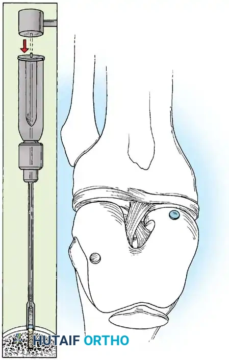 Fig. 48-40, cont’d G, Donor harvester, collared pin, and autograft core reinserted into driver. H, Donor tube harvester inserted into recipient socket. I, Sizer tamp, measuring 1  mm in diameter larger than bone core, positioned over bone core. J, Harvested and transferred cores. (Redrawn from Bobic V, Morgan CD: Osteochondral autograft transfer surgical technique manual, Arthrex, 2000, Naples, Fla.)