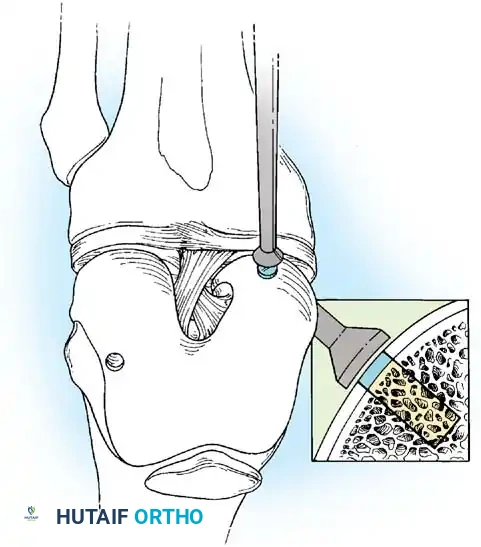 Fig. 48-40, cont’d G, Donor harvester, collared pin, and autograft core reinserted into driver. H, Donor tube harvester inserted into recipient socket. I, Sizer tamp, measuring 1  mm in diameter larger than bone core, positioned over bone core. J, Harvested and transferred cores. (Redrawn from Bobic V, Morgan CD: Osteochondral autograft transfer surgical technique manual, Arthrex, 2000, Naples, Fla.)