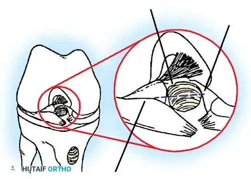1-2 mm posterior wall Slope of medial tibial spine