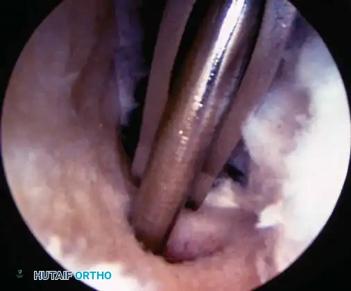 Fig. 48-44, cont’d G, Tibial tunnel should be posterior to roof of altered intercondylar notch to prevent graft impingement in knee extension. H, Use of 7-mm femoral offset guide to assist with femoral guidewire placement. I, Derotation slot at 12-o’clock position on femoral tunnel to allow guidewire placement and viewing of recessed graft and to prevent posterior migration of interference screw. J, Use of probe to guide graft into femoral tunnel, with cancellous portion of graft directly anterior. K, With knee ﬂ exed more than 100 degrees, guidewire is placed up femoral tunnel through middle cannula. Interference screw is passed, ensuring that guidewire and traction suture is a straight line and ensuring minimal divergence between screw and bone plug. L, Use of sheath to protect graft and to assist in placing screw parallel to graft.